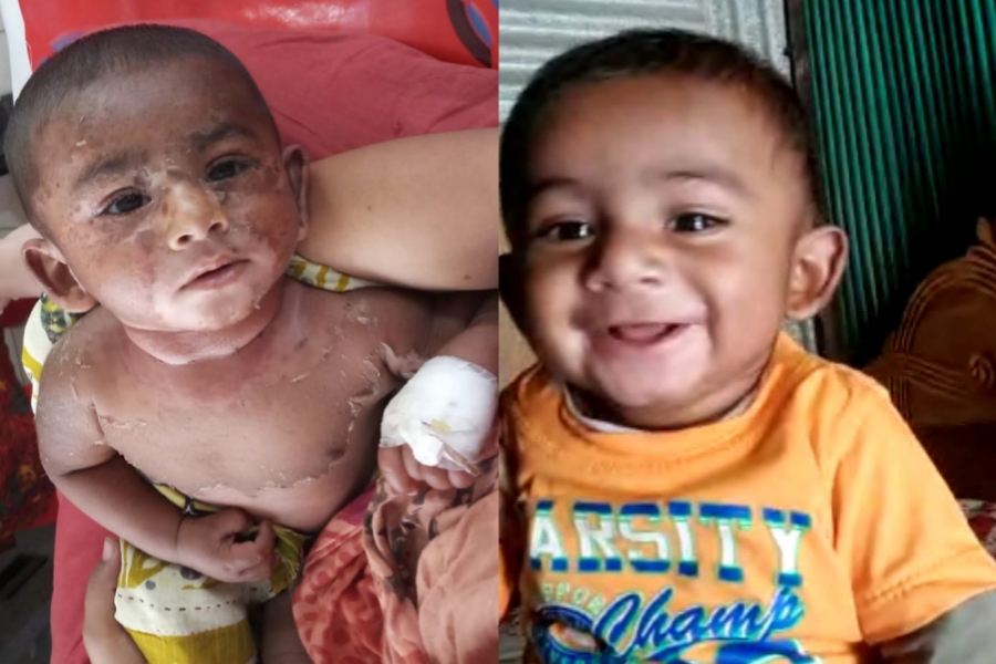 দাউদকান্দিতে পল্লী চিকিৎসকের ওষুধ খেয়ে ঝলসে গেলো শিশু, তদন্ত কমিটি